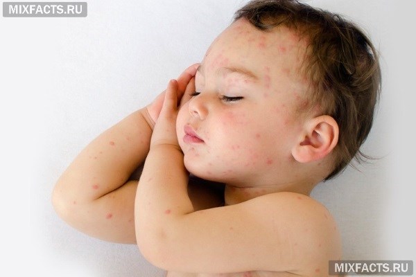 Аллергическая сыпь по всему телу у ребенка 