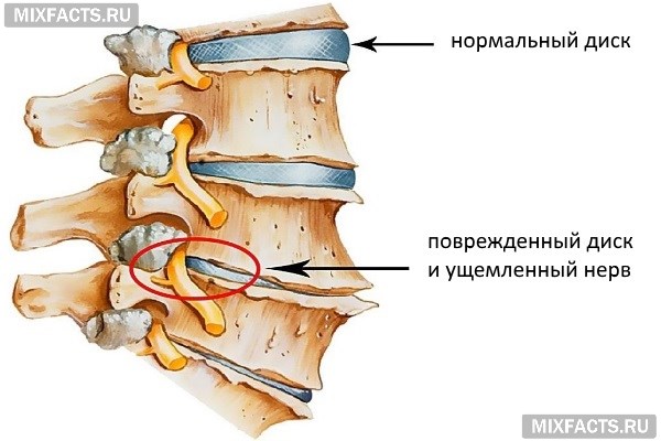 Какие уколы при защемлении нерва в шейном отделе thumbnail