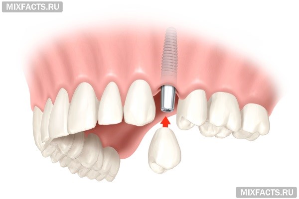 Можно ли восстановить зуб, у которого осталась одна стенка или корень?