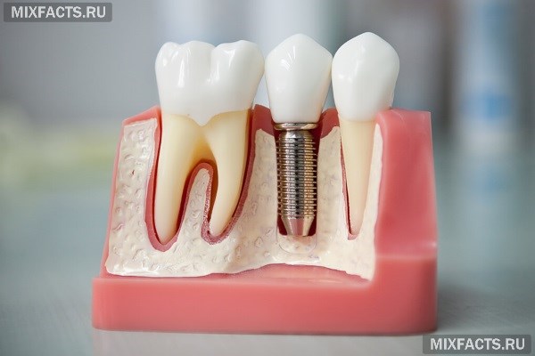 Можно ли восстановить зуб, у которого остался один корень или стенка?