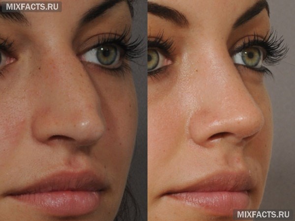 Изменить форму носа с помощью ринопластики 