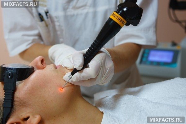 Как проходит удаление жировика лазером на лице и теле?