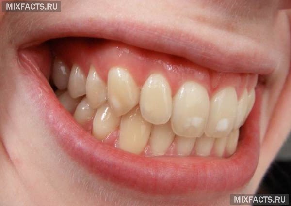 Белое пятно на зубе 